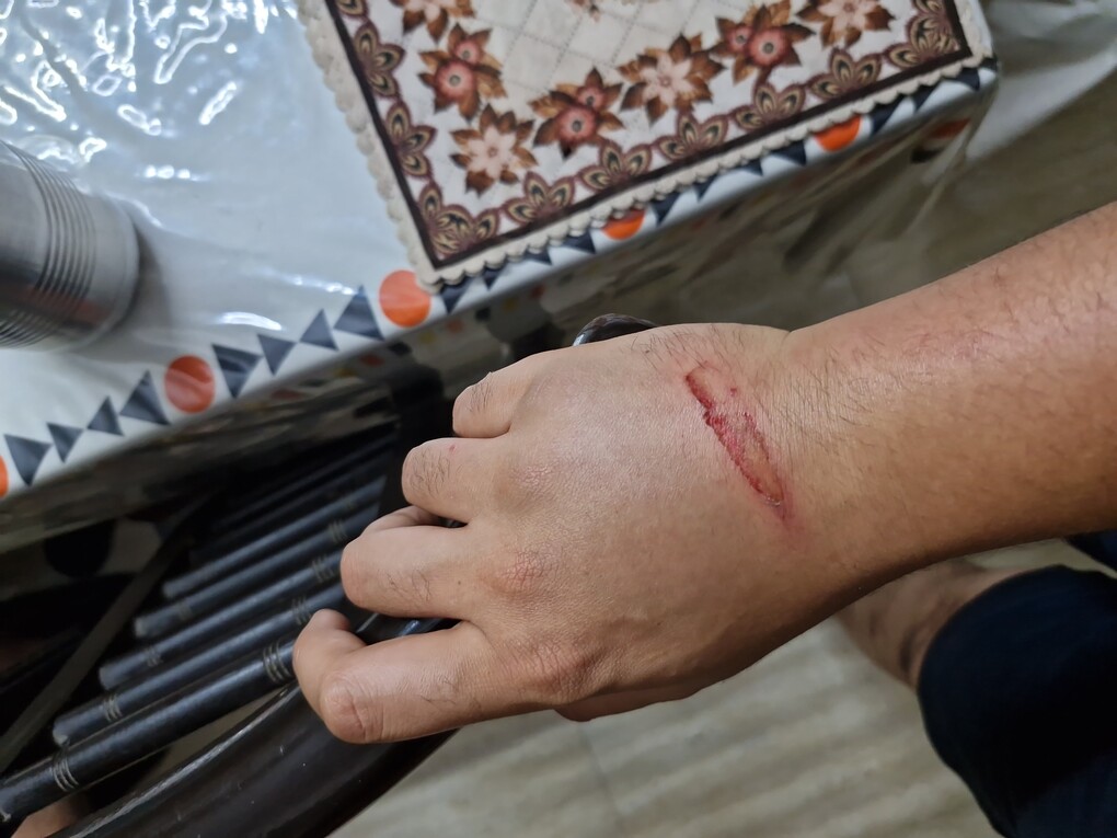 Photograph of the back of my right hand. There's a red gash around 2.5" long near the wrist.