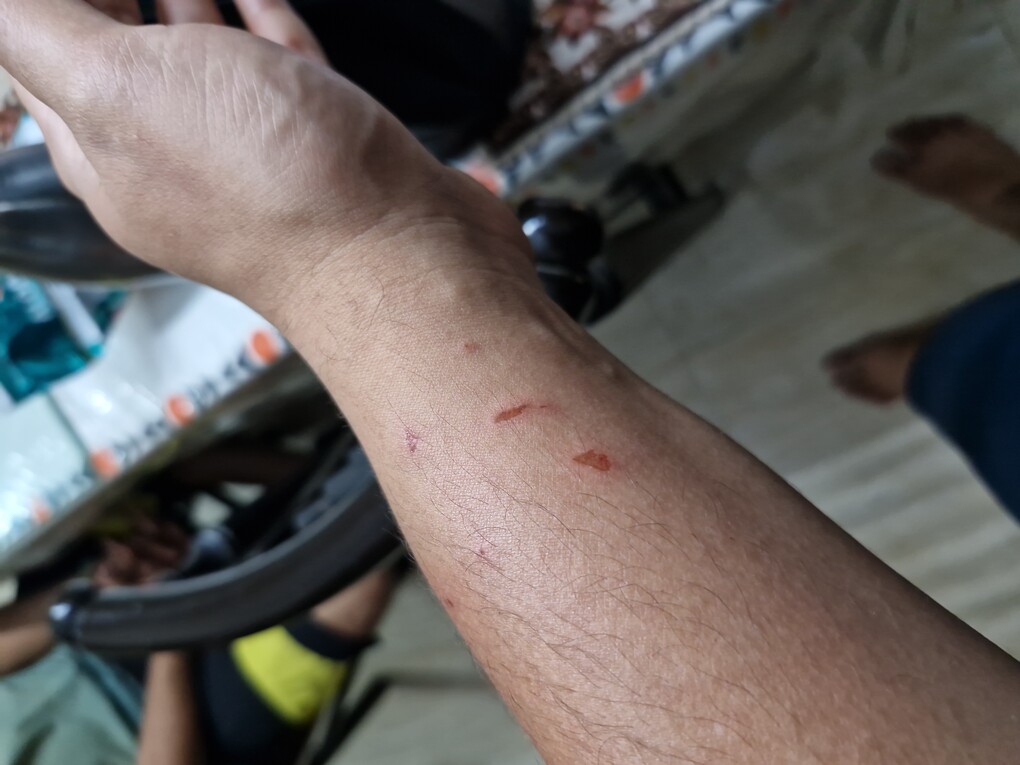 Photograph of my left forearm. There are 4 red wounds seemingly made by nails.