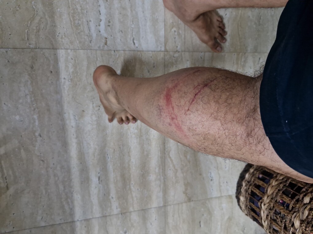 Photograph of my right calf, with multiple large red marks