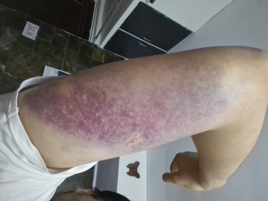 Photograph of the back of my right arm. The underarm is almost completely purple from bruising.