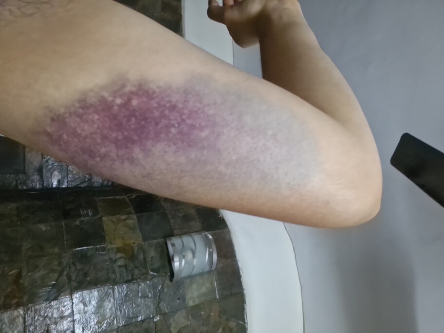 Photograph of the back of my left arm, with a significant purple bruise, and a larger blue bruise which almost completely covers the upper arm.